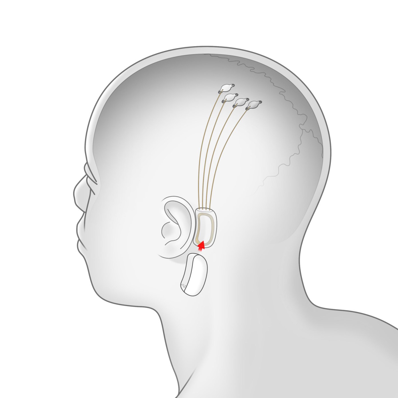 Մասկի Neuralink ստարտափն առաջին անգամ ներկայացրել է գլխուղեղի և համակարգչի կապակցման իր տեխնոլոգիան